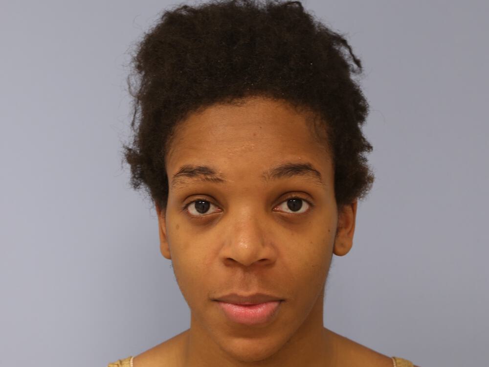 Facial Feminization Before & After Image