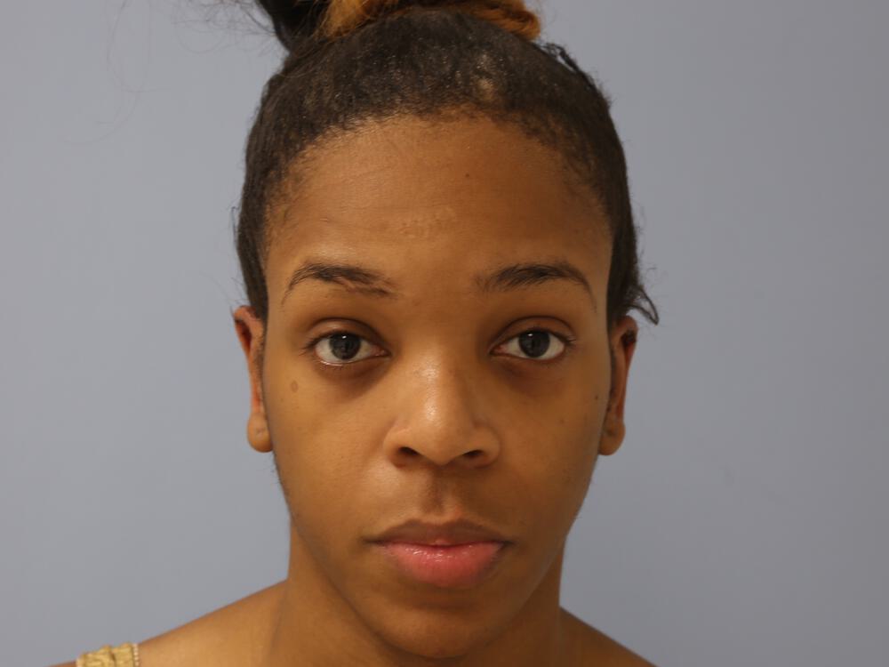 Facial Feminization Before & After Image