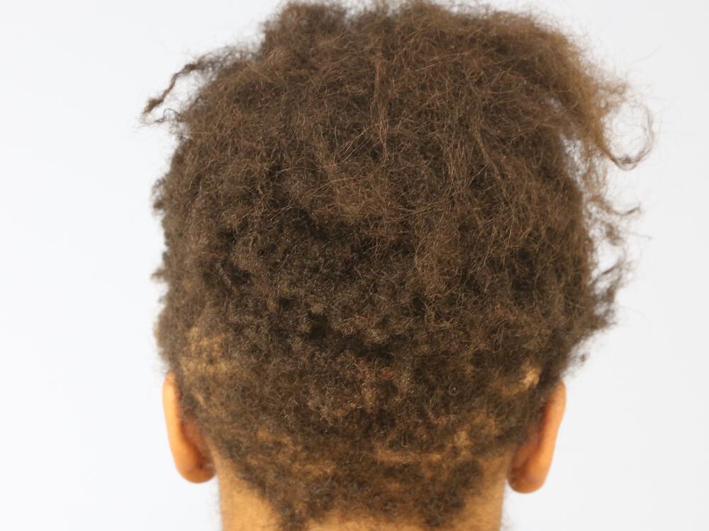 Facial Feminization Before & After Image