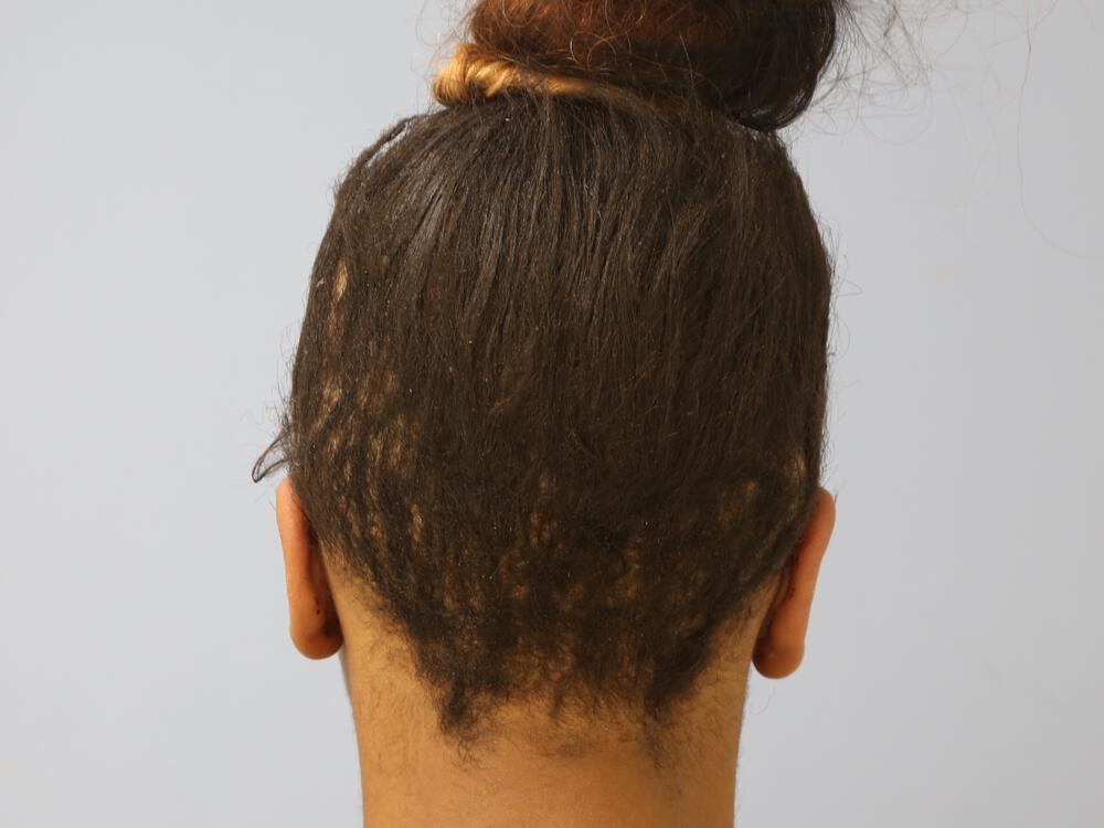 Facial Feminization Before & After Image