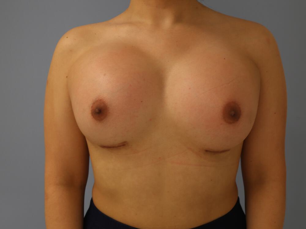 M-F Breast Augmentation Before & After Image