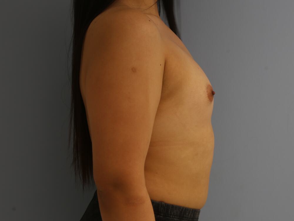 M-F Breast Augmentation Before & After Image