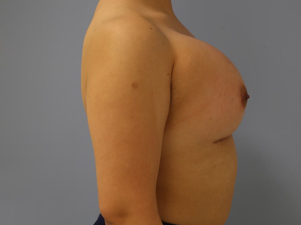 M-F Breast Augmentation Before & After Image