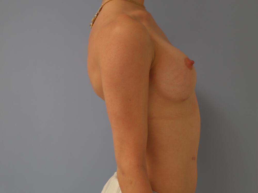 M-F Breast Augmentation Before & After Image