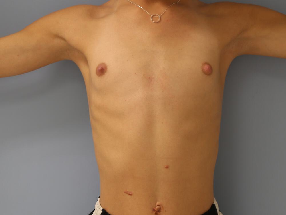 M-F Breast Augmentation Before & After Image