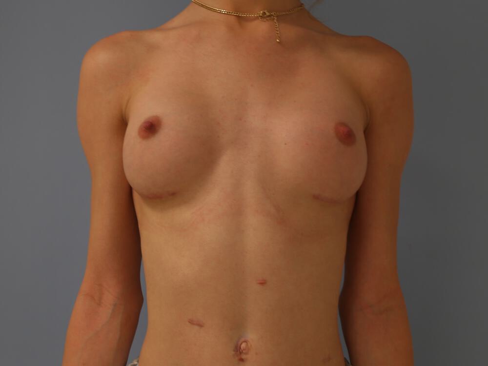 M-F Breast Augmentation Before & After Image
