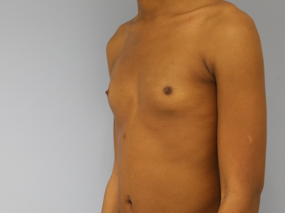 M-F Breast Augmentation Before & After Image