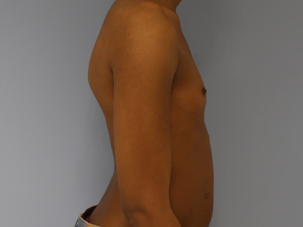 M-F Breast Augmentation Before & After Image